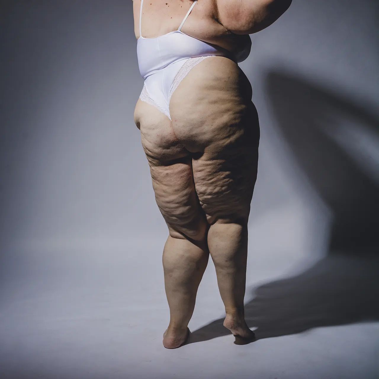 Lipedema e Linfedema Erechim