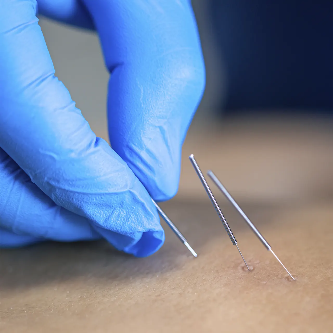 Dry needling
